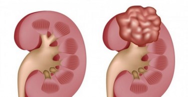 Signs and Symptoms of Kidney Cancer