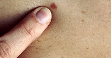 Signs and symptoms of skin cancer