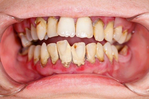 Gum Disease linked to kidney disease