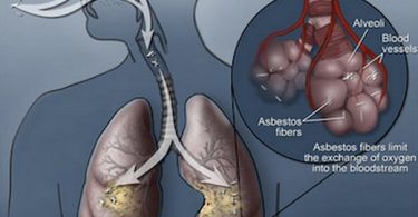 Signs and Symptoms of Asbestos Lung Cancer