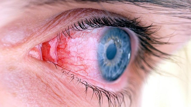 Crohn’s disease, inflammation of eyes