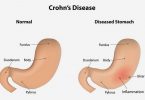 Symptoms of Crohn’s disease