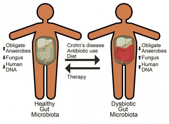 Understanding the symptoms of Crohn’s disease