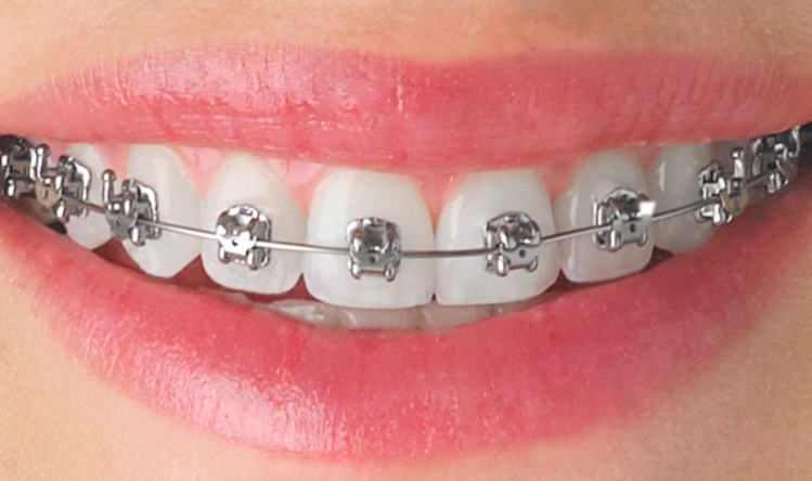 Benefits of Early Orthodontic Treatment