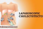 Gallstones Laparoscopic Surgery Removal