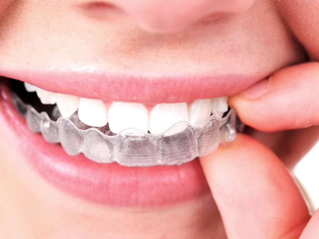 Can Treatment Using Invisalign Reshape a Crooked Smile?