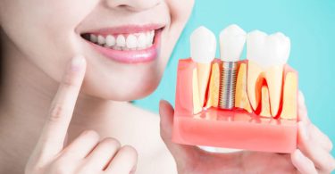 What to Eat After Dental Implants Procedure?