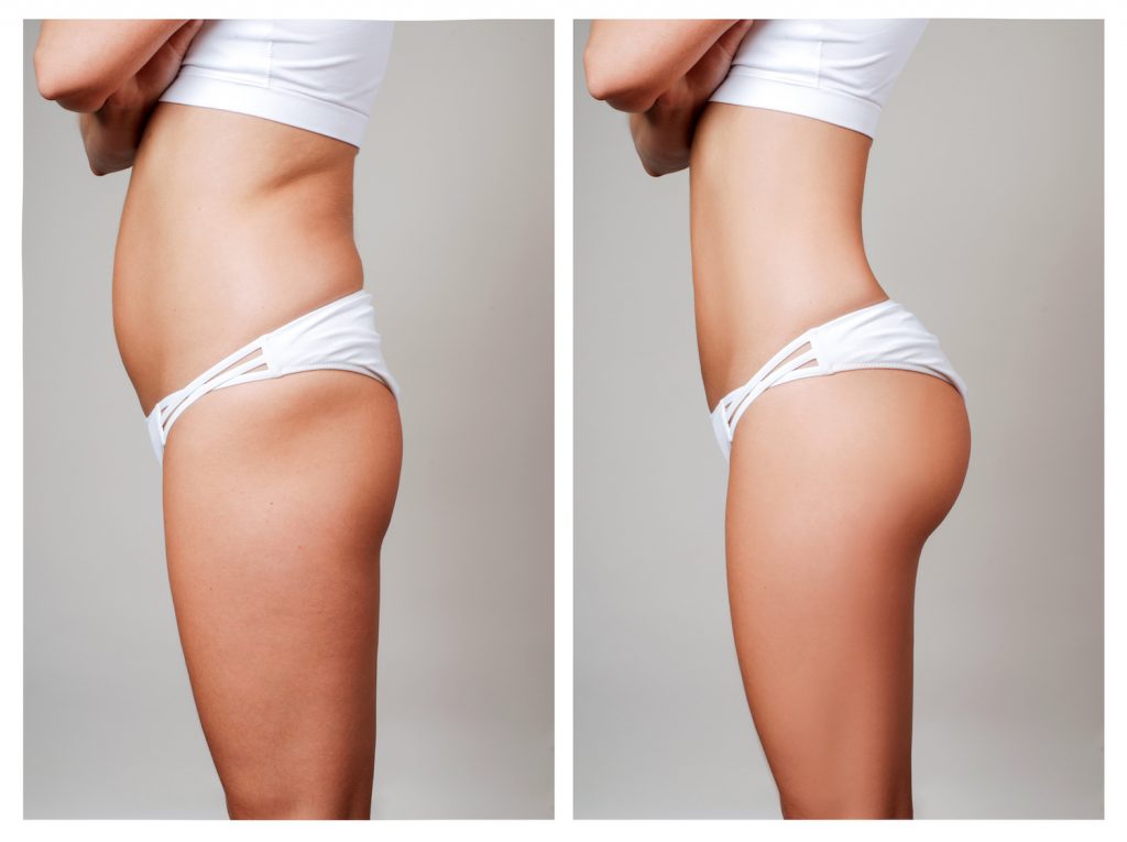 Tummy Tuck Surgery