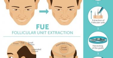 Find High-Quality FUE Hair Transplant Clinic in Delhi