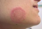 Fungal and Yeast Infections