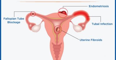 Female infertility