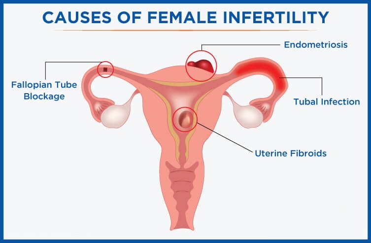 Female infertility