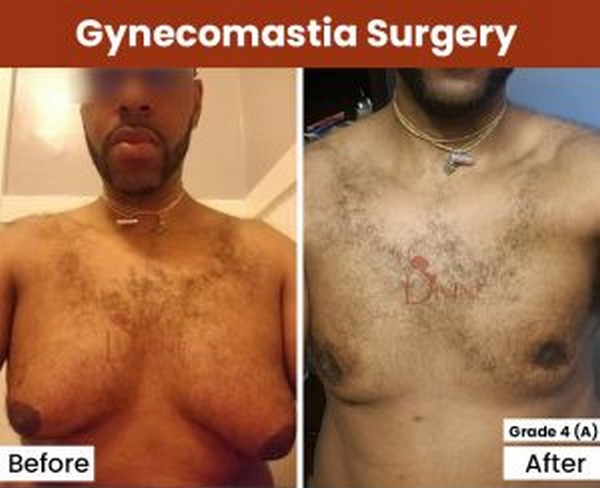 Gynecomastia Surgery