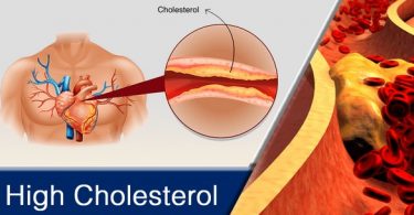 Effects of High Cholesterol on the Body