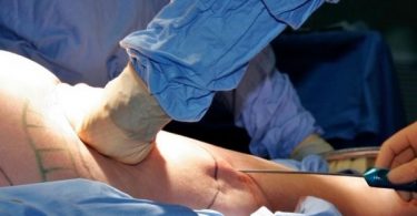 Liposuction surgery procedure