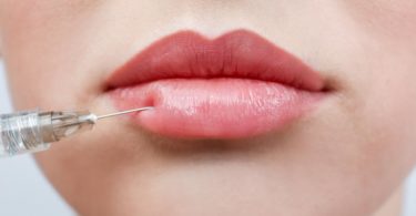 What is lip augmentation