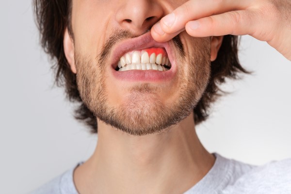 common causes of gum disease