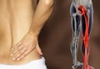 Sciatic Nerve Pain