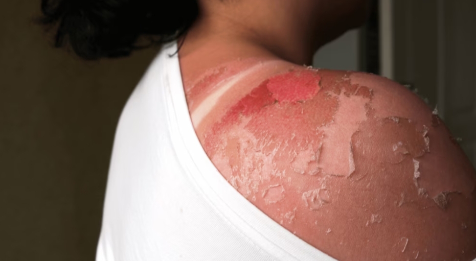 Burn Injury Attorneys