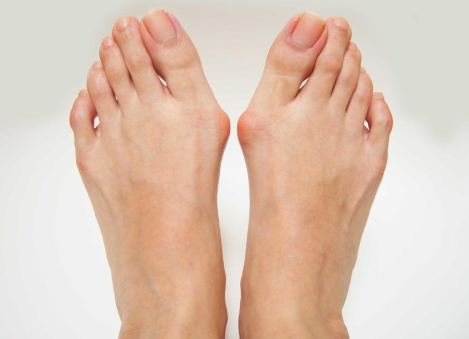 Bunions