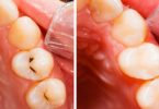 Facts About Tooth Filling