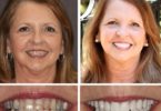 full mouth reconstruction