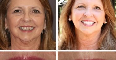 full mouth reconstruction