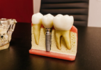 Procedure of Dental Implants