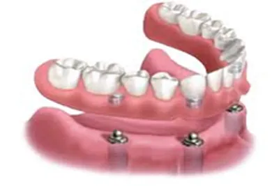 single tooth implant
