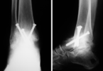 Ankle Fusion Surgery