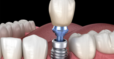 Benefits of a Single Tooth Implant