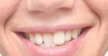 Best Treatments for Misaligned Teeth