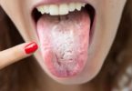 Candida infections