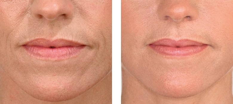 Dermal Filler Injections